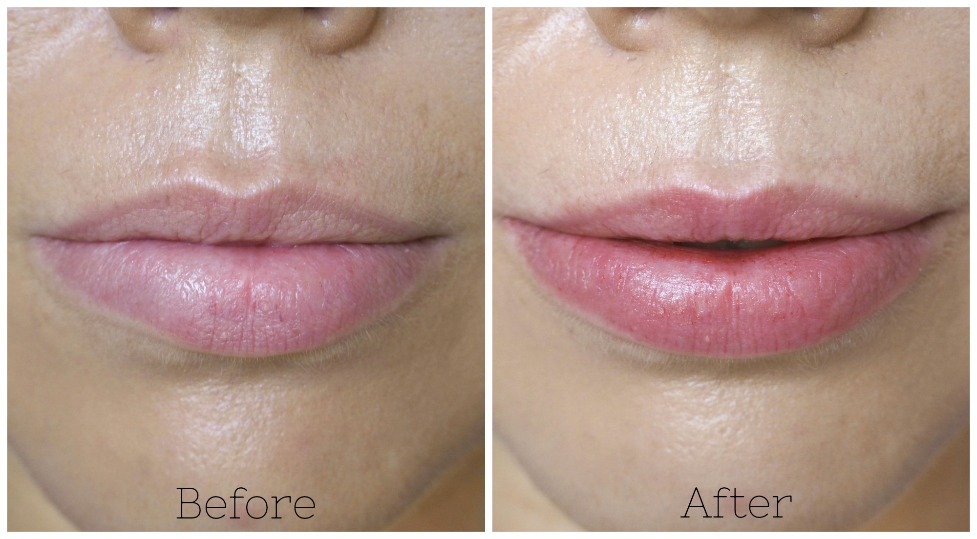 National Kissing Day with the PMD KISS lip plumping device. Laura