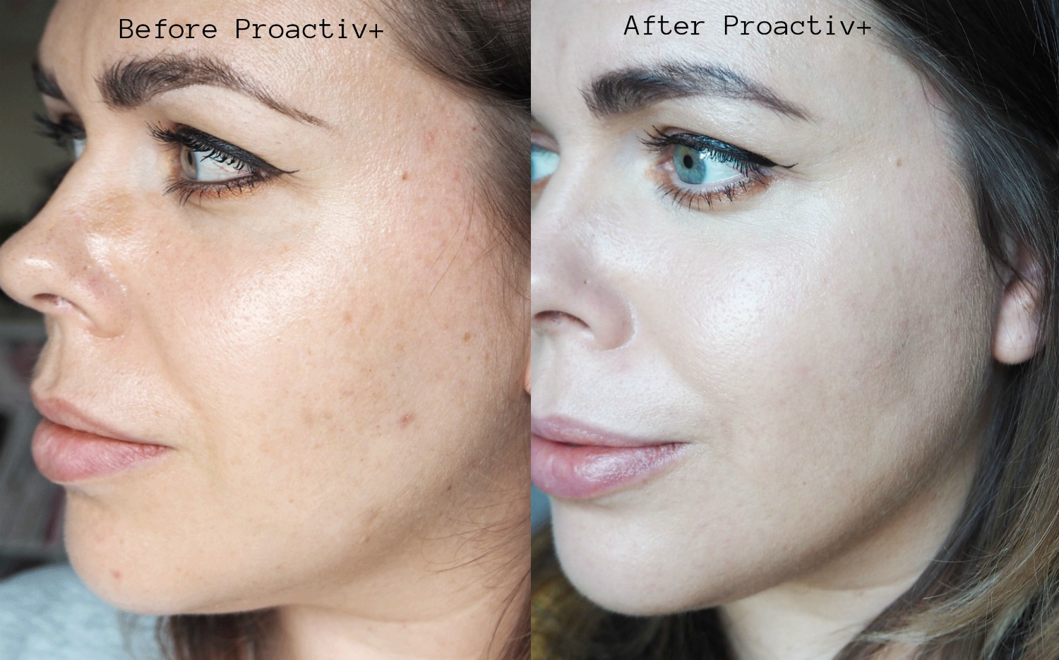 Proactiv Skincare My Journey Experience Laura Louise Makeup Proactiv Skincare My Journey Experience Laura Louise Makeup