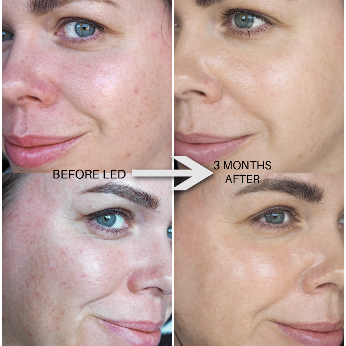 Currentbody LED mask 6 month results