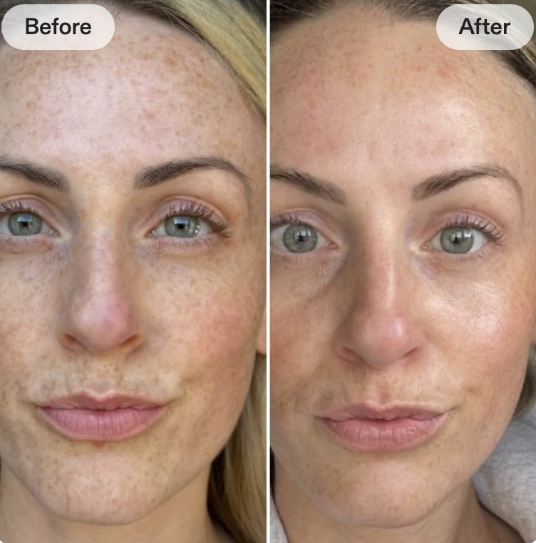 LED Masks and pigmentation