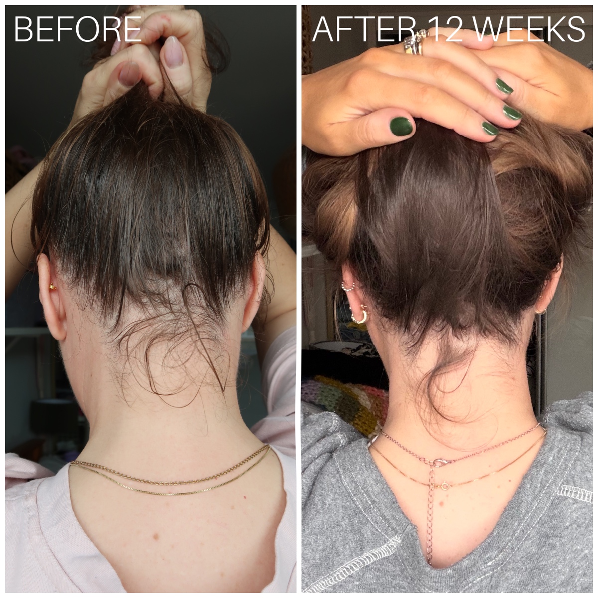 currentbody LED hair growth helmet results before and after