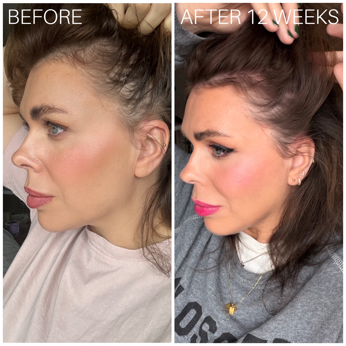 currentbody LED hair growth helmet results before and after