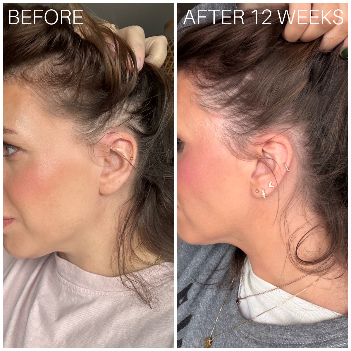 currentbody LED hair growth helmet results before and after