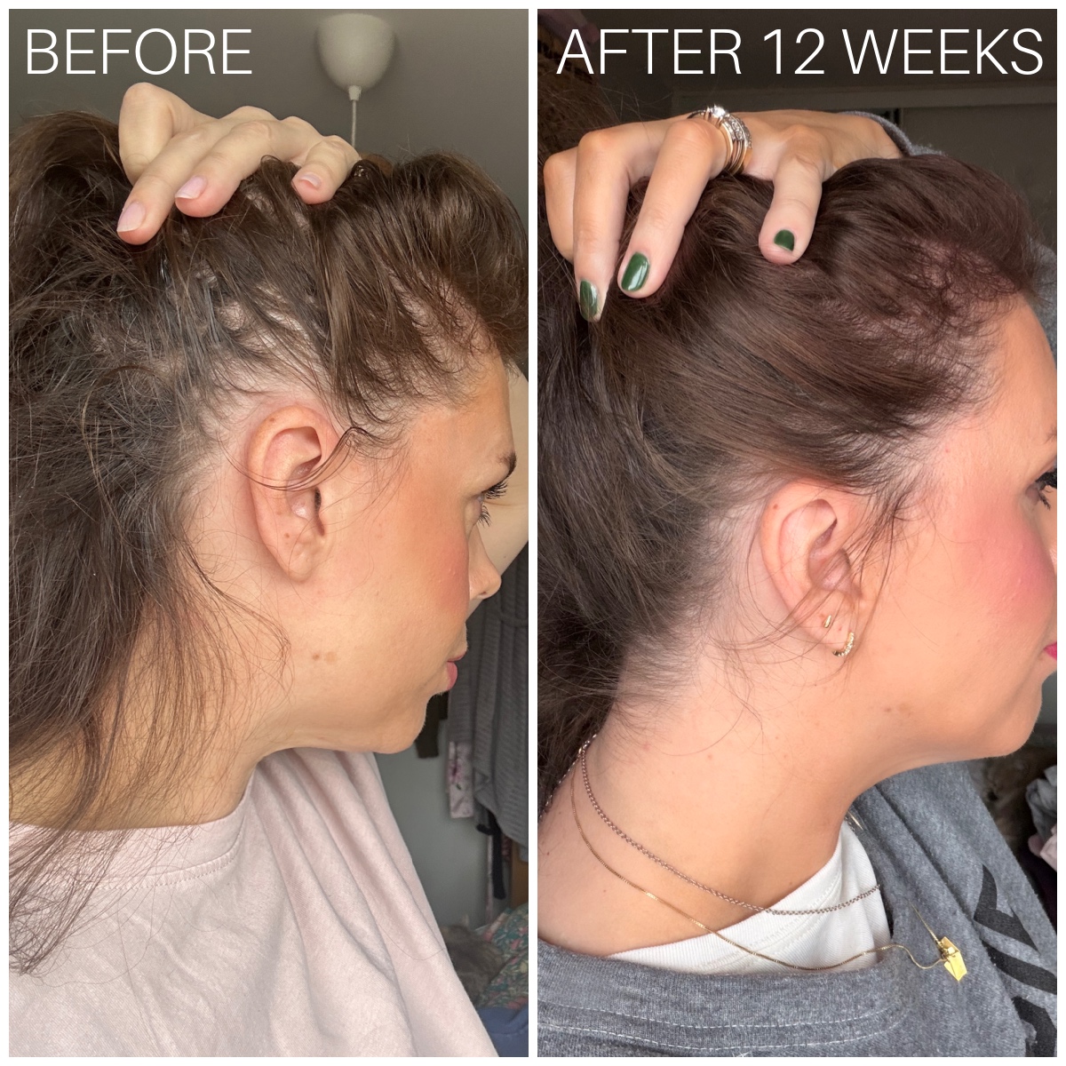 currentbody LED hair growth helmet results before and after