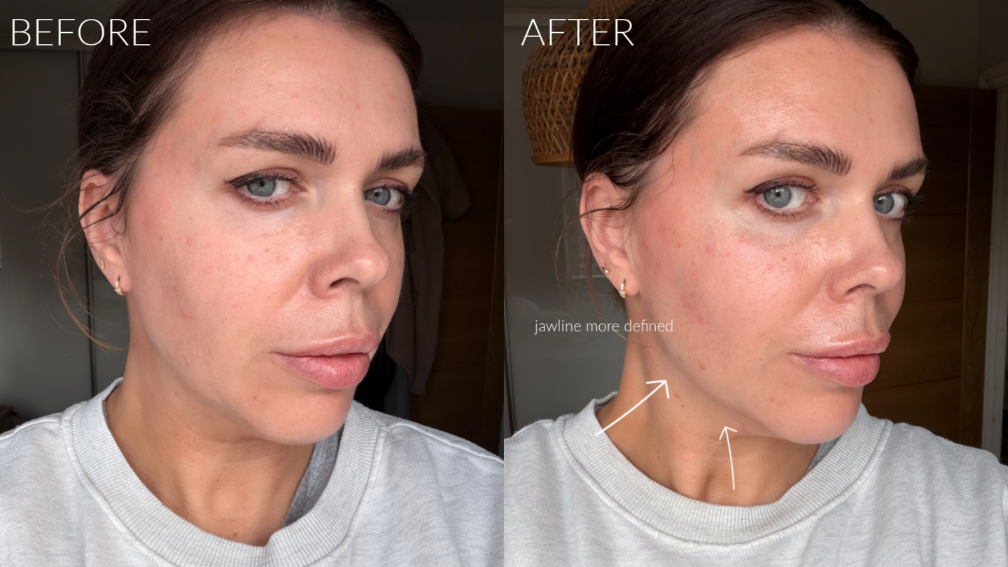 ZIIP Halo 2 review and before afters