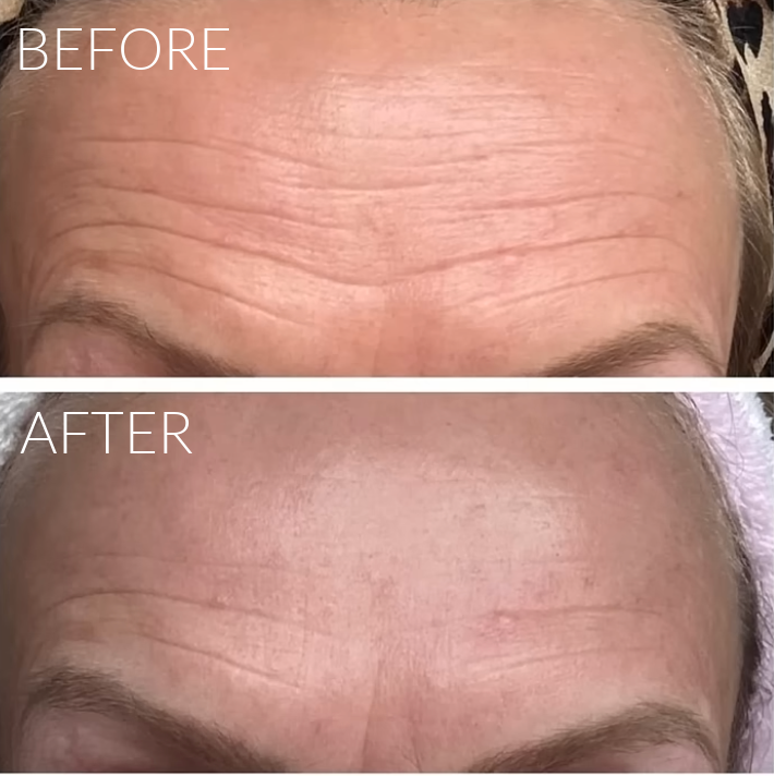 ZIIP Halo 2 review and before afters