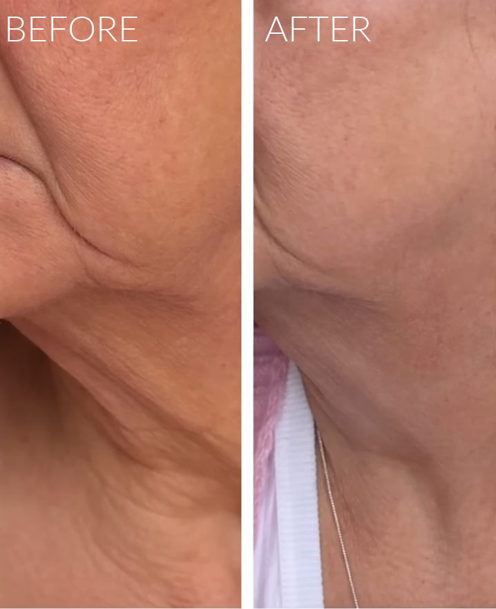 ZIIP Halo 2 review and before afters