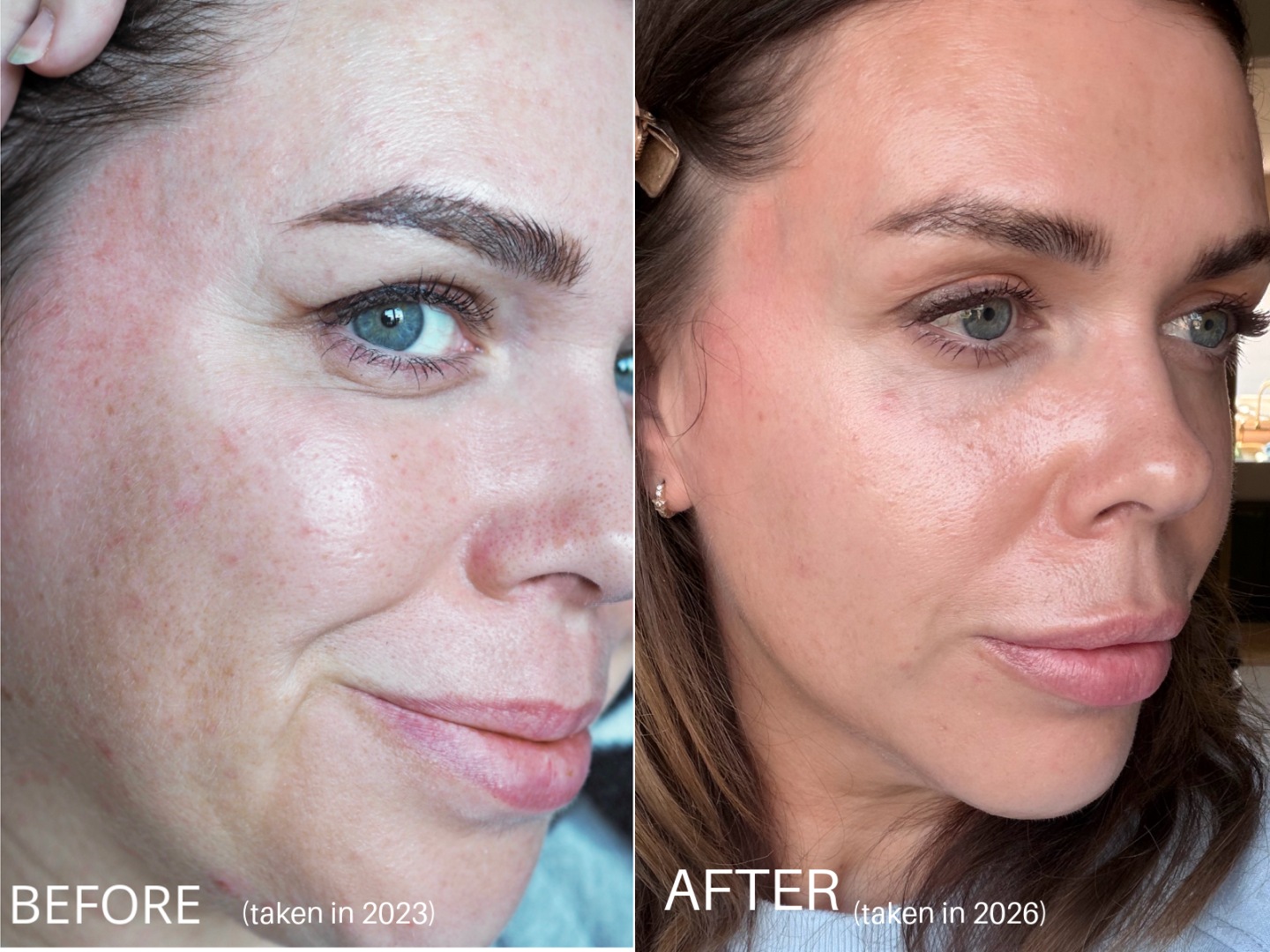 which LED red light therapy mask is best 2026