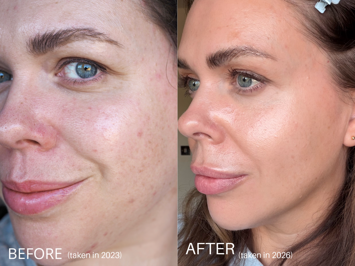 which LED red light therapy mask is best 2026