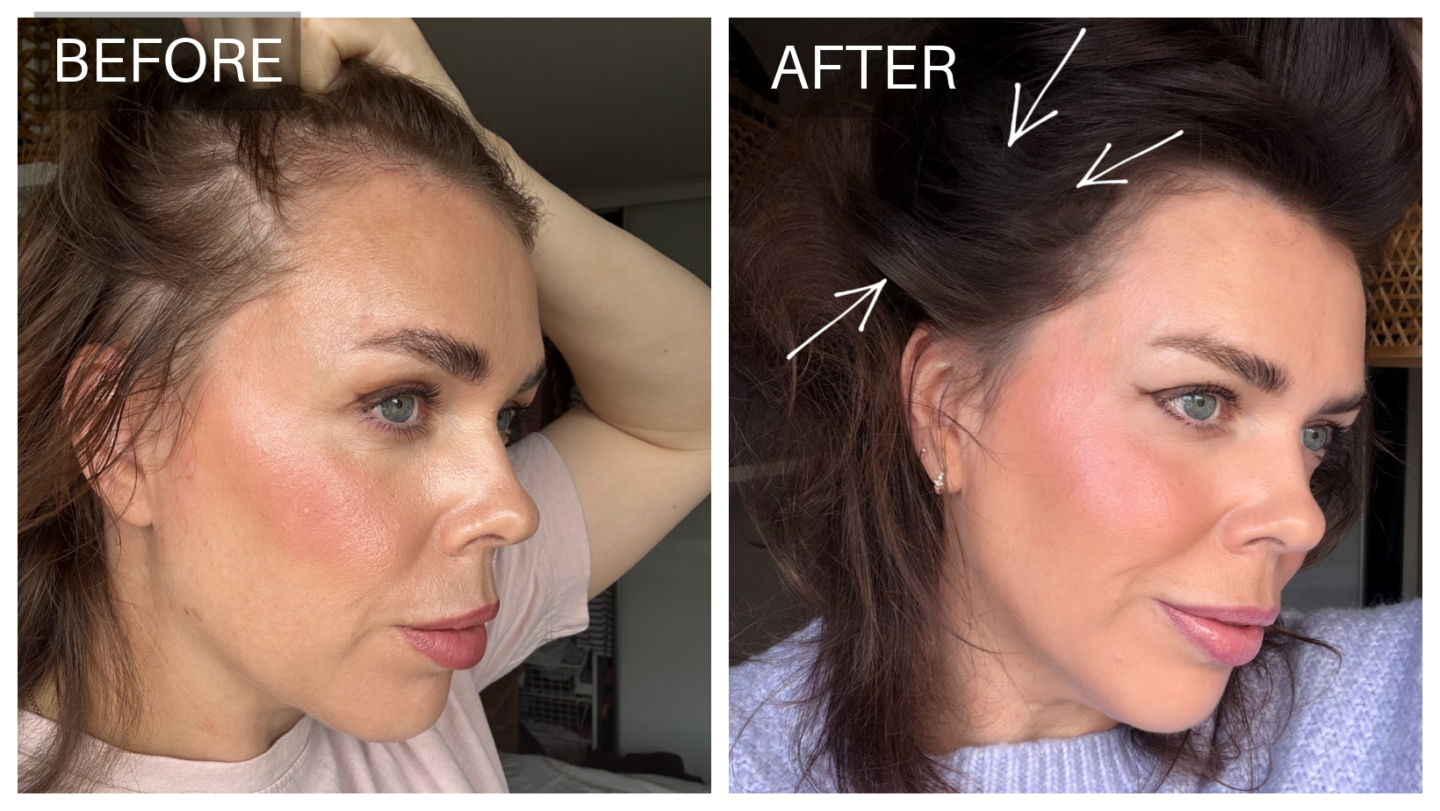 Hair thinning before and after treatment