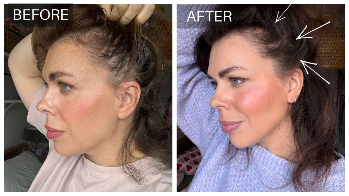 current body LED hair growth helmet before and after