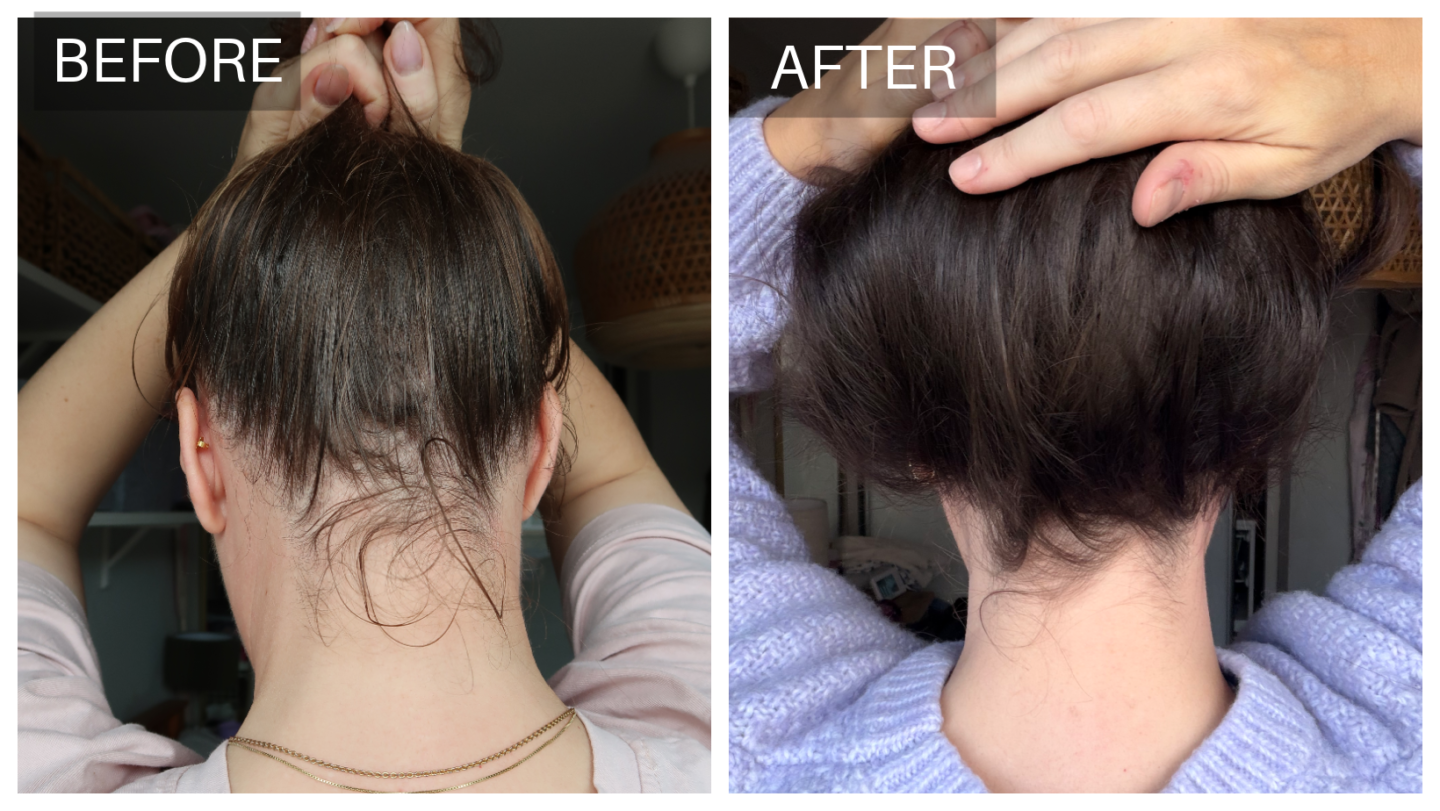 Hair thinning before and after treatment